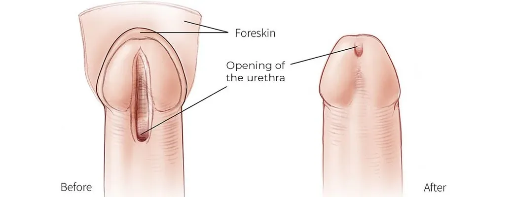 Urologie pédiatrique