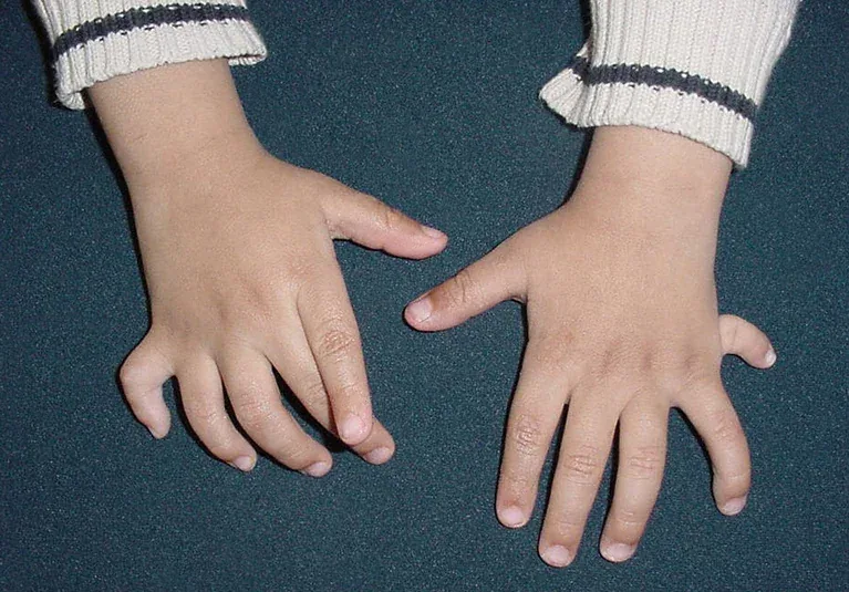 Malformations de la main