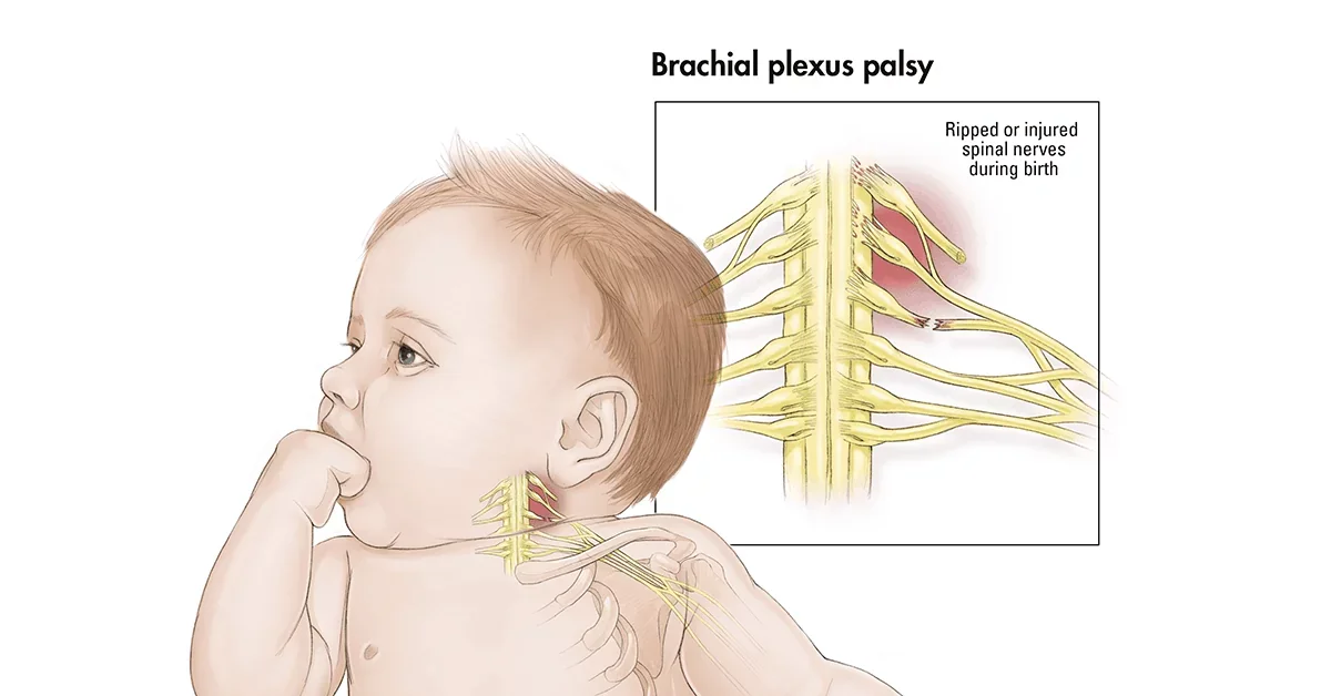 Paralysie du plexus brachial